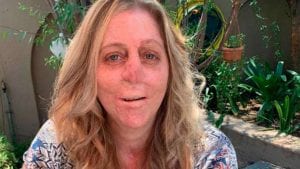 Mujer perdió extremidades luego de mordedura de un mangosta-Momento24