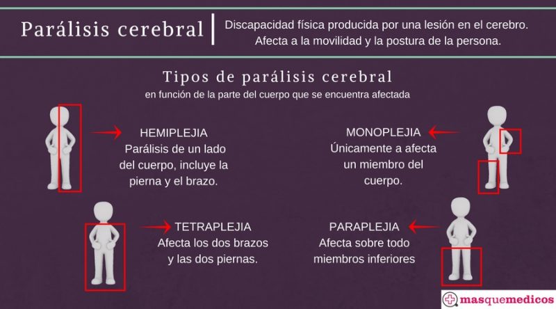 Tipos De Parálisis Cerebral Infantil - Neuronas En Crecimiento