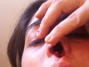 Mujer perdió el cartílago de su nariz por prueba PCR mal hecha