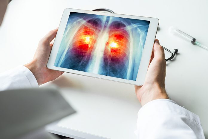 Nueva tecnología que detecta a tiempo cáncer de pulmón