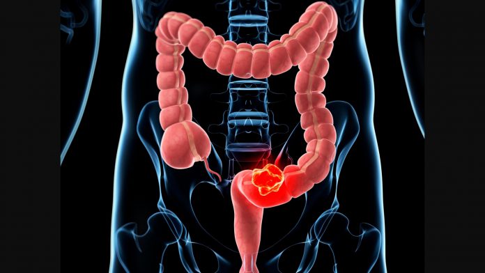 Cáncer de colon: una patológica común pero tratable