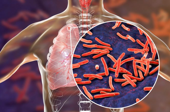 La tuberculosis: Un problema de salud global